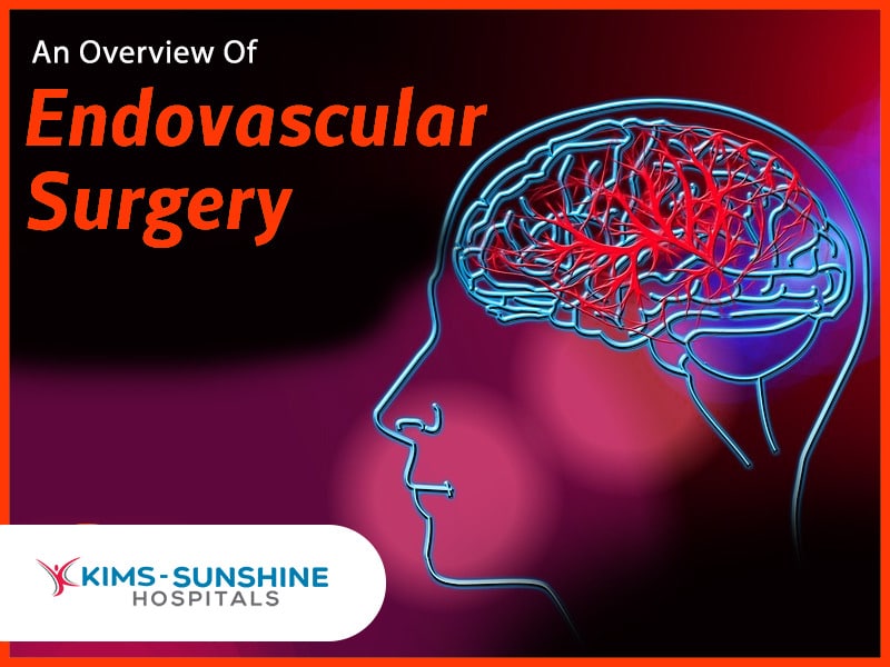 A Complete Overview Of Endovascular surgery Multispeciality Hospital