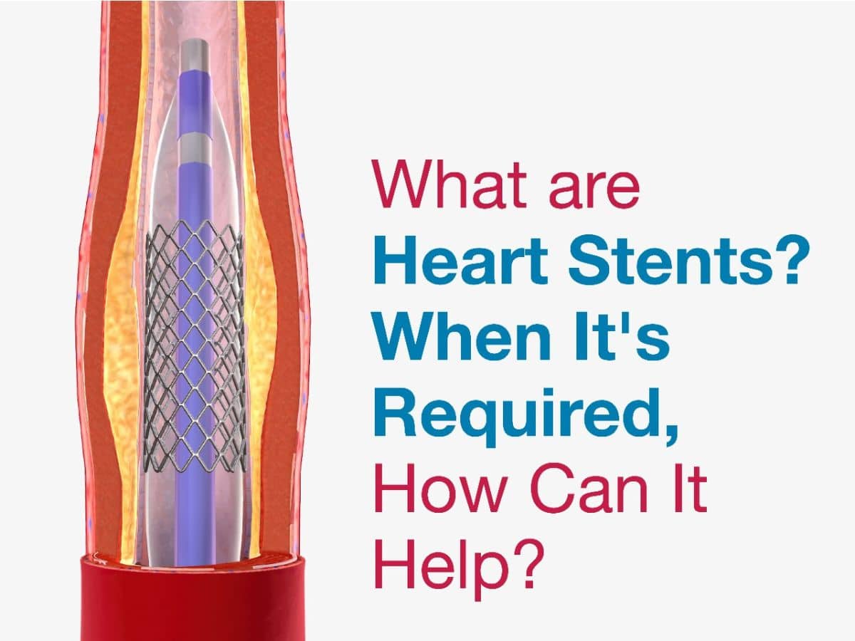 What are Heart Stents? When It’s Required, What Errors to Avoid, How Can It Help? KIMS
