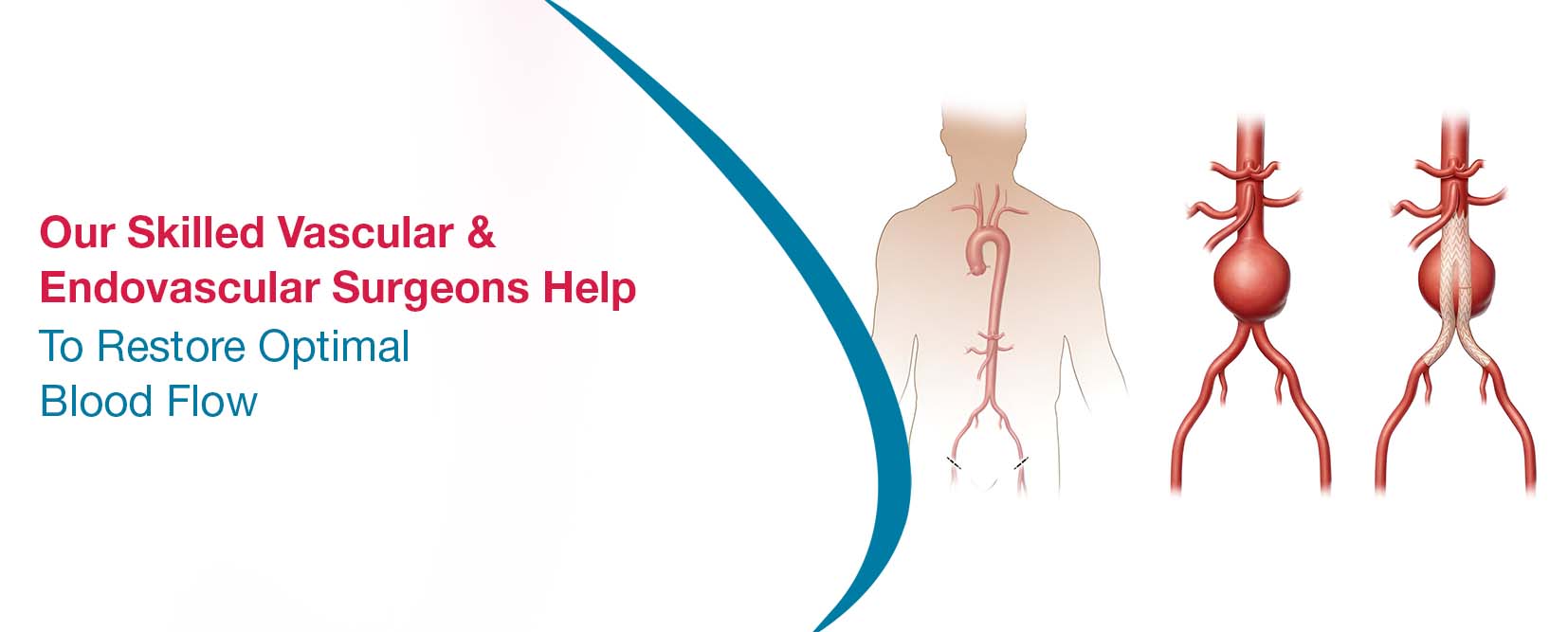 Best Vascular & Endovascular Surgery In Hyderabad