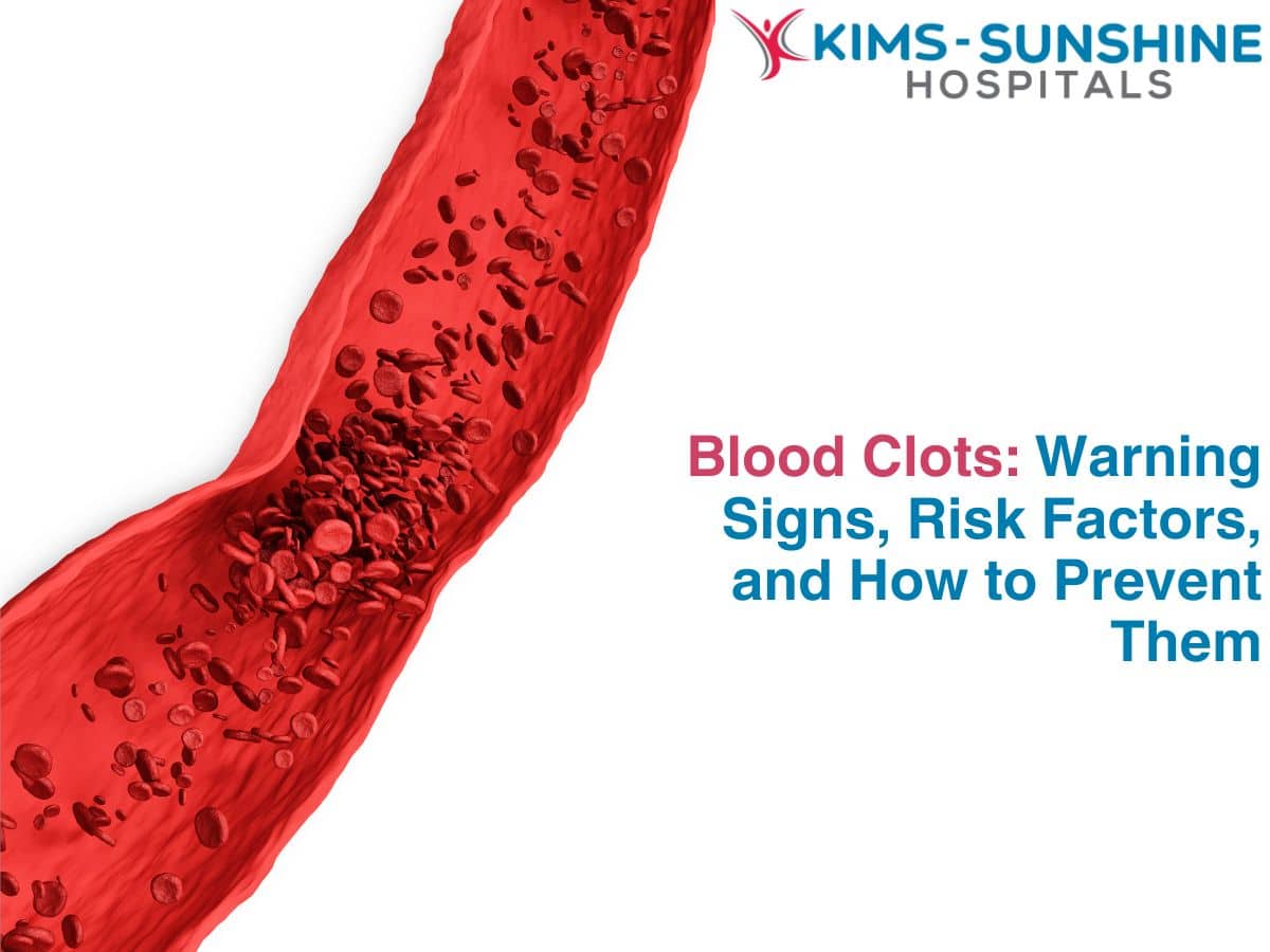 Blood Clots: Warning Signs, Risk Factors, and How to Prevent Them