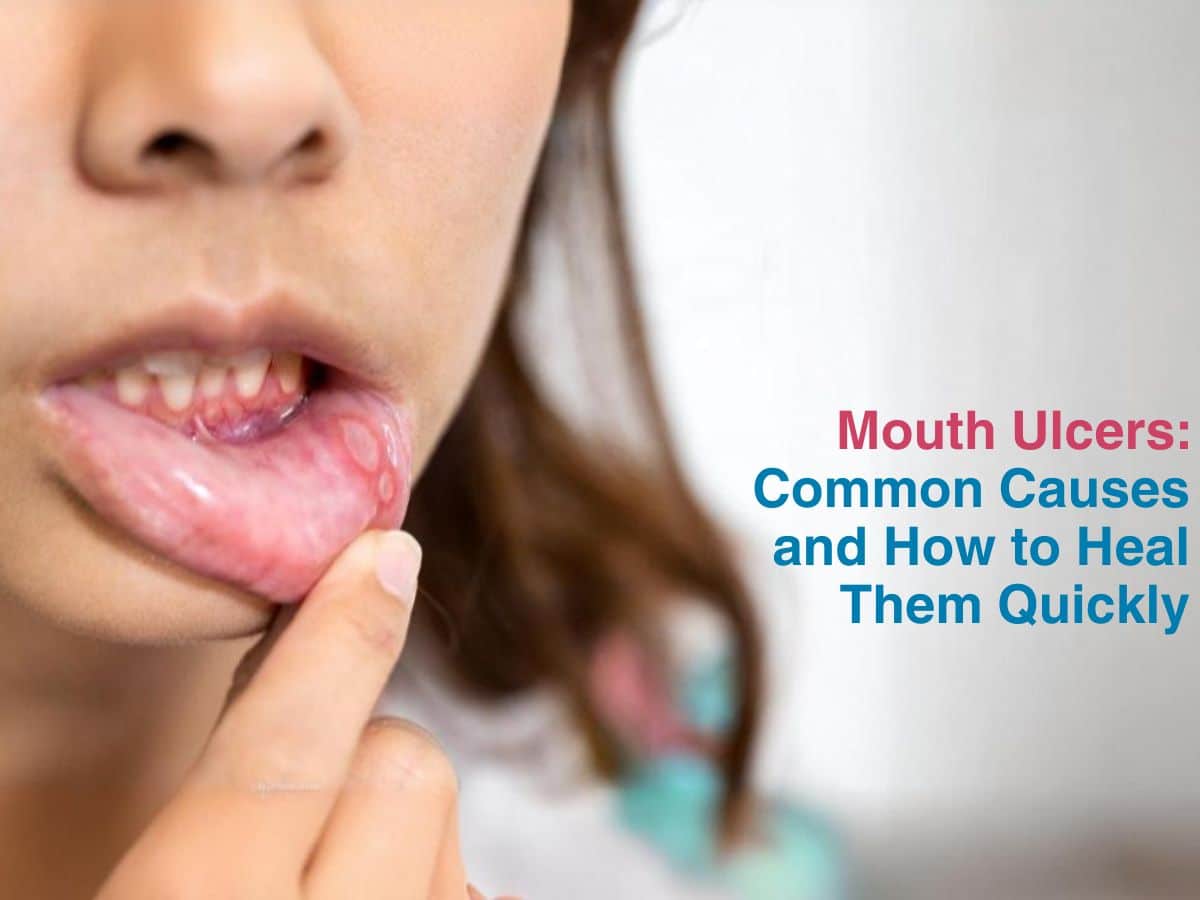 Mouth Ulcers: Common Causes and How to Heal Them Quickly