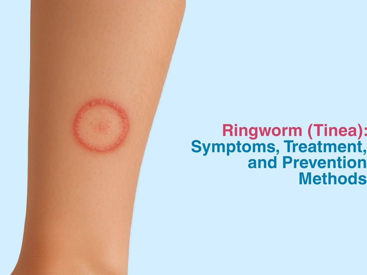 Ringworm (Tinea)_ Symptoms, Treatment, and Prevention Methods