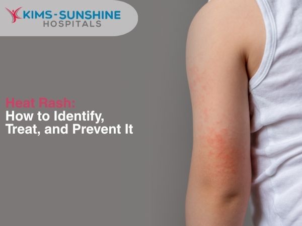 Heat Rash: How to Identify, Treat, and Prevent It
