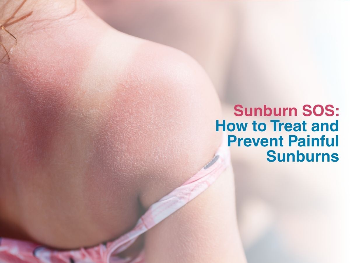 Sunburn SOS: How to Treat and Prevent Painful Sunburns