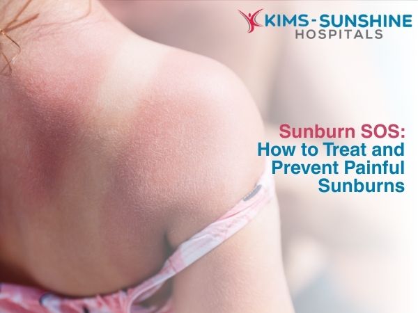 Sunburn SOS: How to Treat and Prevent Painful Sunburns