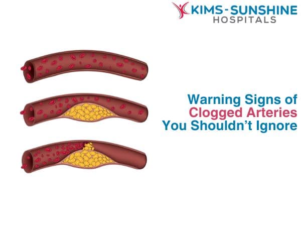 Warning Signs of Clogged Arteries You Shouldn’t Ignore