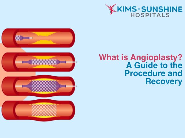 What is Angioplasty? A Guide to the Procedure and Recovery