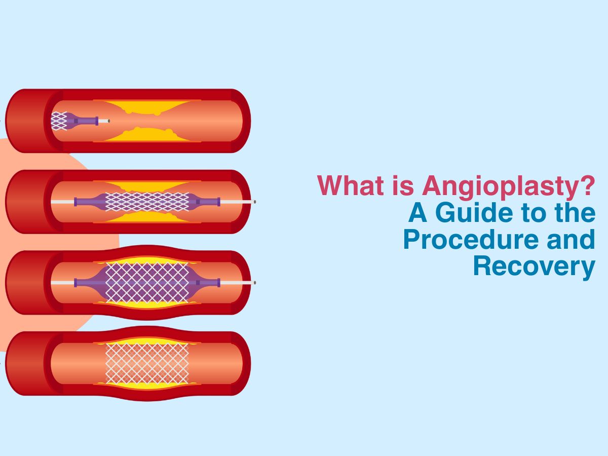 What is Angioplasty? A Guide to the Procedure and Recovery
