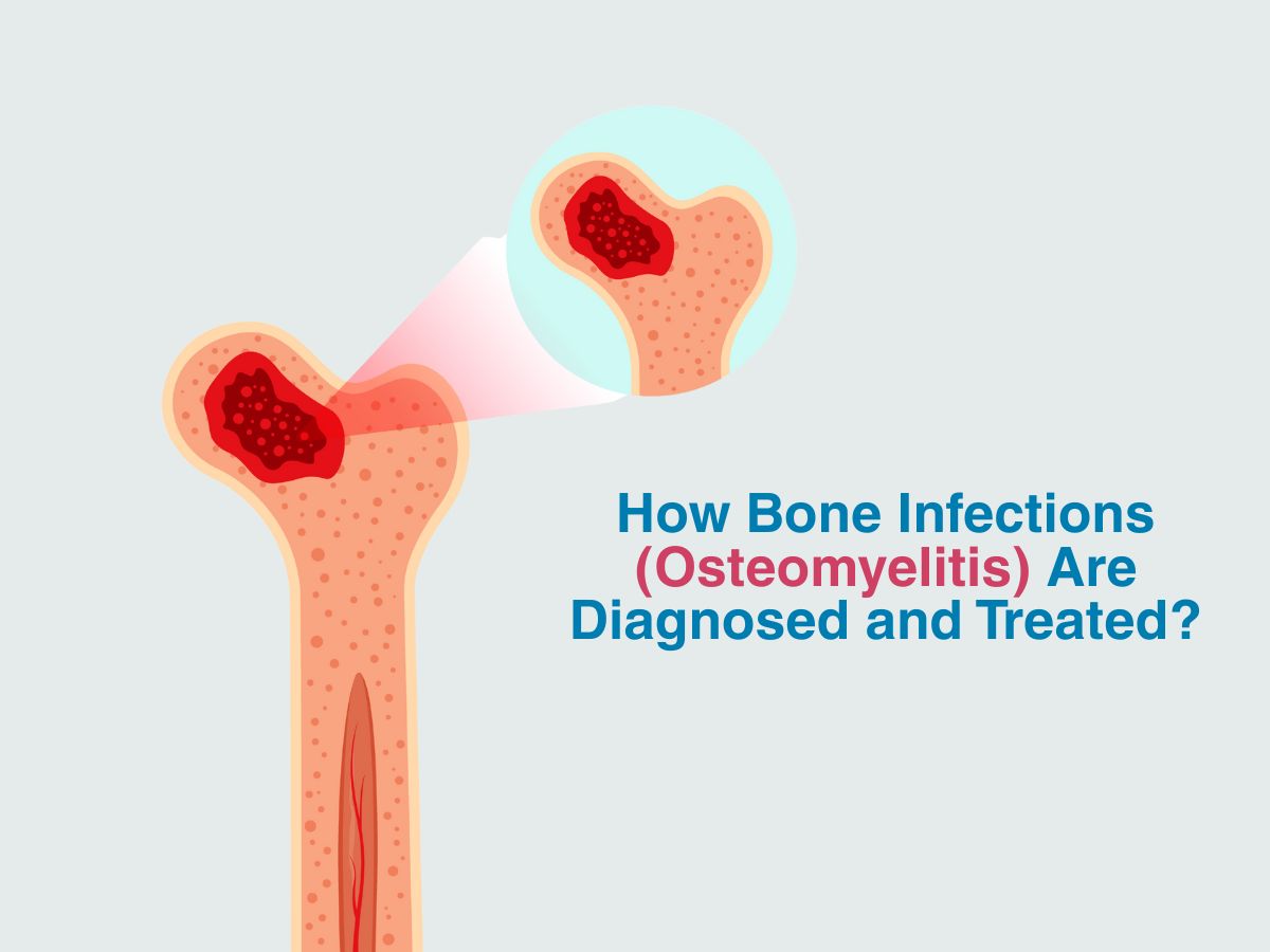 How Bone Infections (Osteomyelitis) Are Diagnosed and Treated