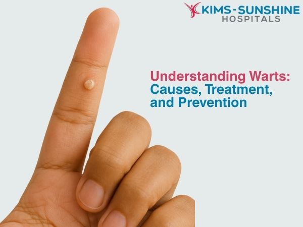 Understanding Warts_ Causes, Treatment, and Prevention