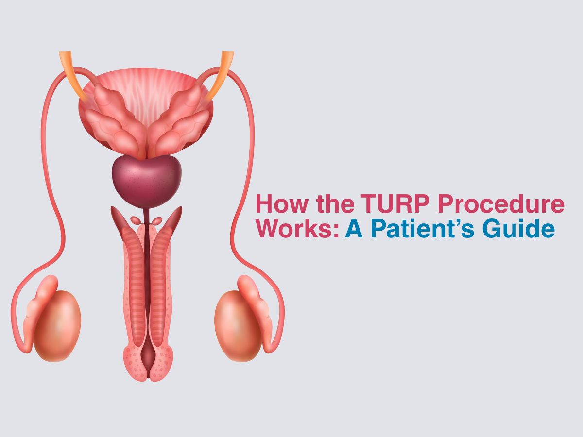 How the TURP Procedure Works: A Patient’s Guide 