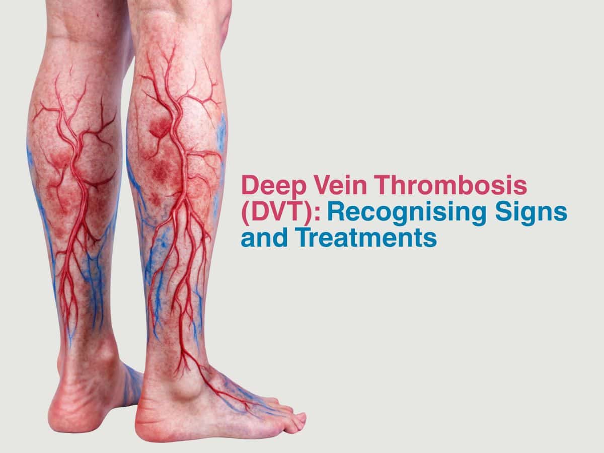 June -Deep Vein Thrombosis (DVT)_ Recognising Signs and Treatments