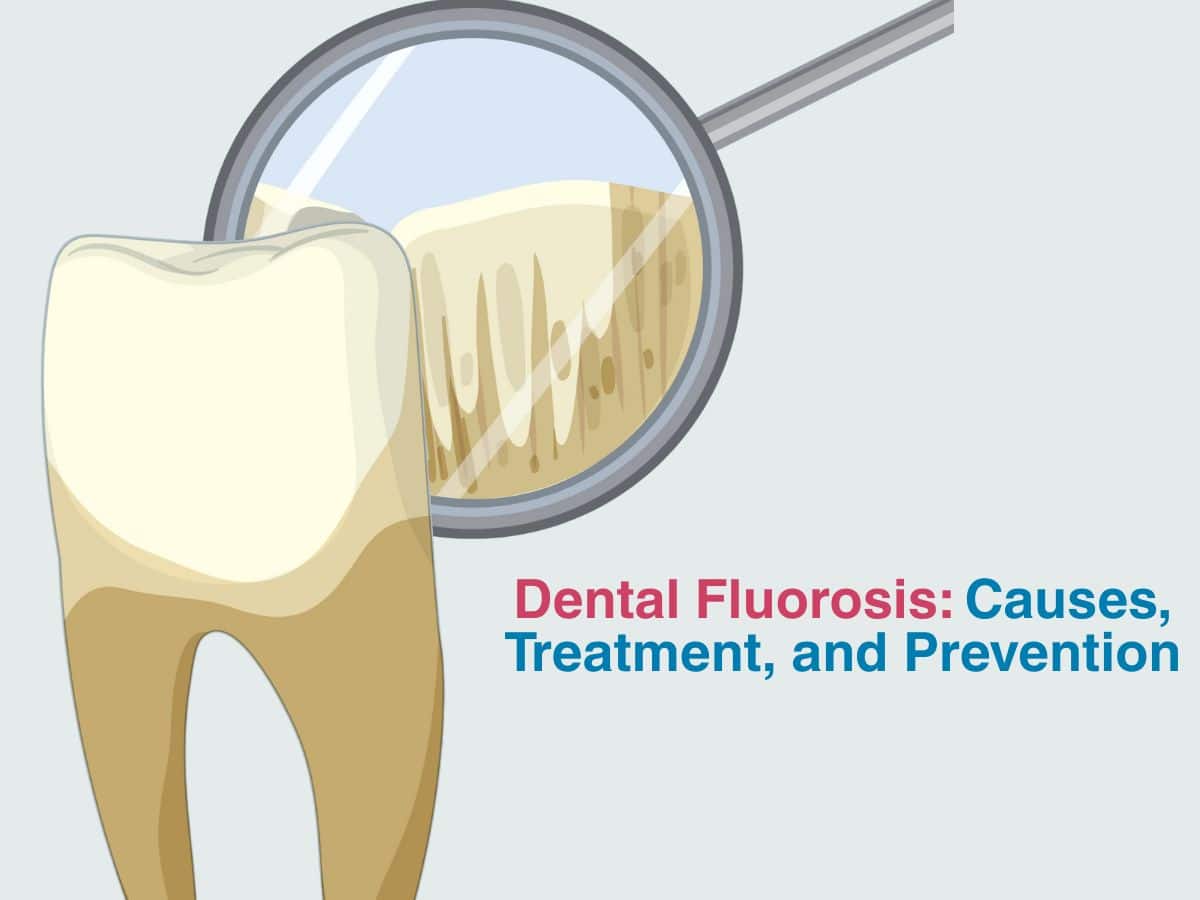 June -Dental Fluorosis_ Causes, Treatment, and Prevention