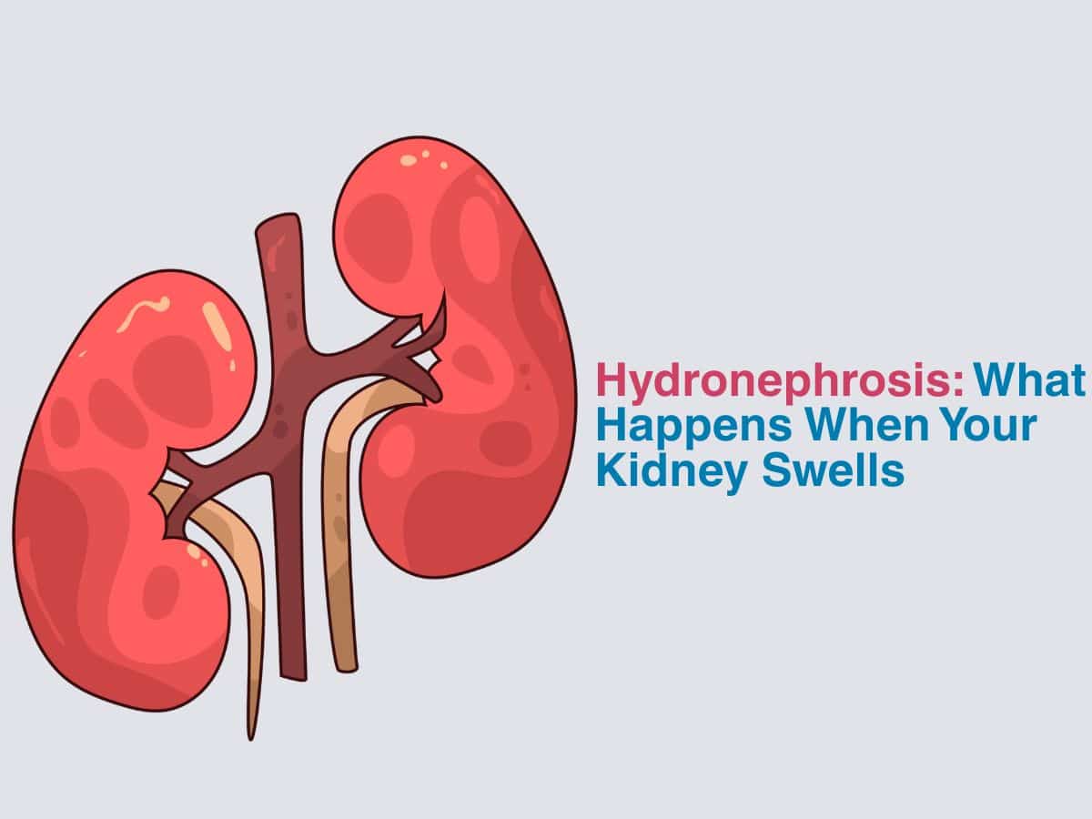 June -Hydronephrosis_ What Happens When Your Kidney Swells