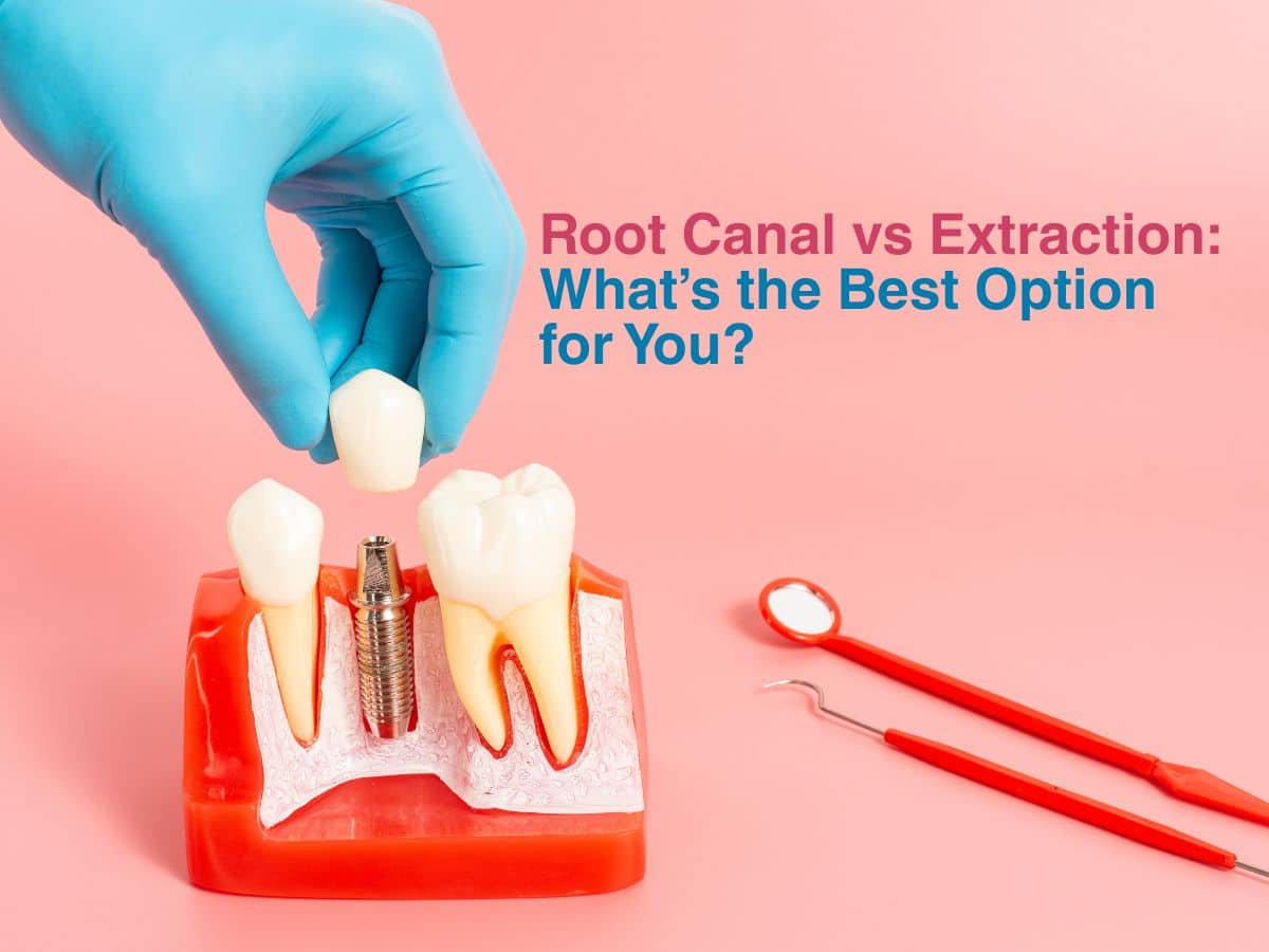 Root Canal vs Extraction: What’s the Best Option for You? 