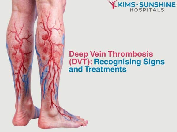 June-Thumbnail -Deep Vein Thrombosis (DVT)_ Recognising Signs and Treatments