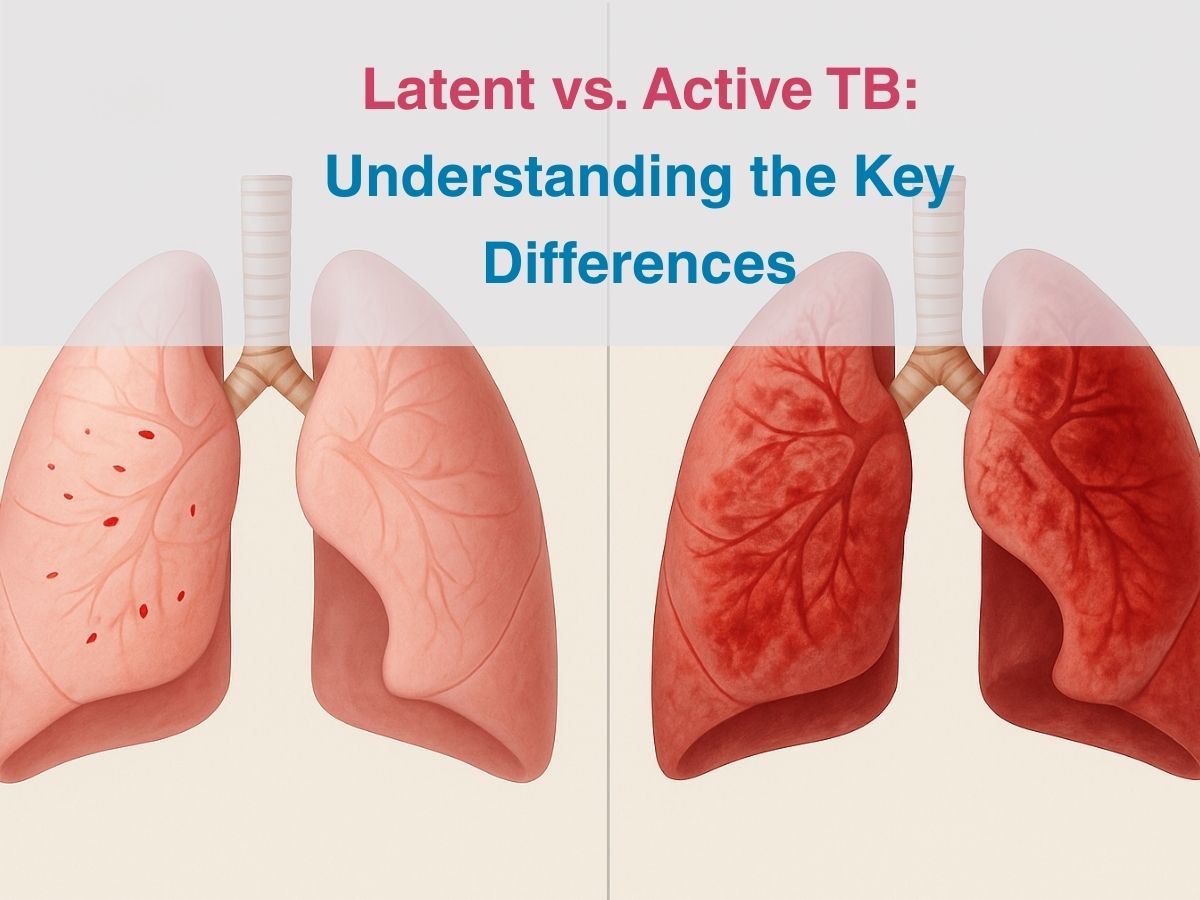 Latent vs. Active TB: Understanding the Key Differences