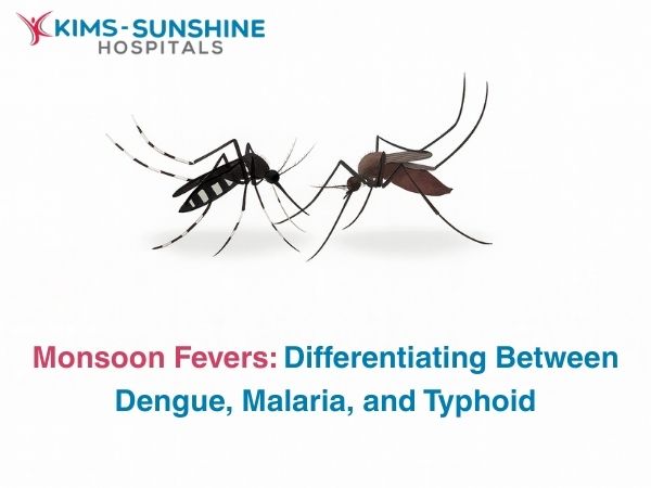 Monsoon Fevers: Differentiating Between Dengue, Malaria, and Typhoid