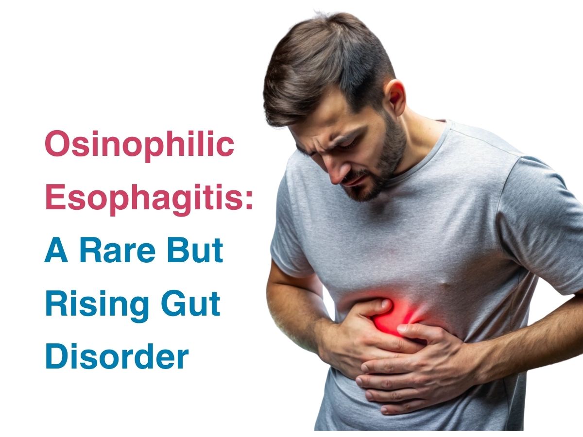 Eosinophilic Esophagitis: A Rare But Rising Gut Disorder