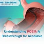 Understanding POEM: A Breakthrough for Achalasia