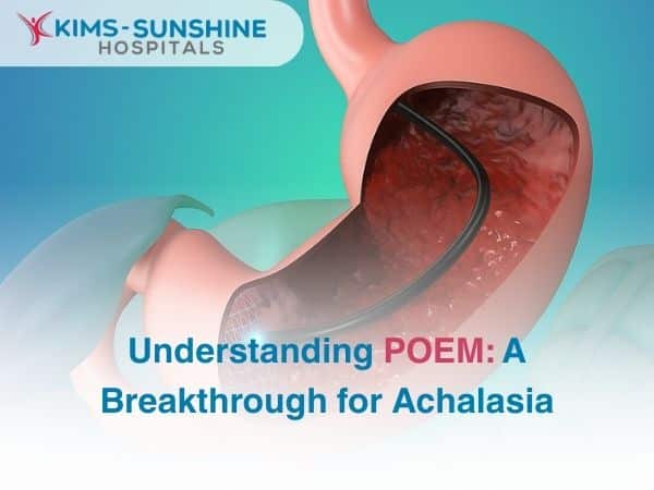 Understanding POEM: A Breakthrough for Achalasia