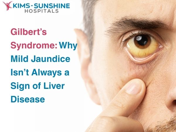 Gilbert’s Syndrome: Why Mild Jaundice Isn’t Always a Sign of Liver Disease