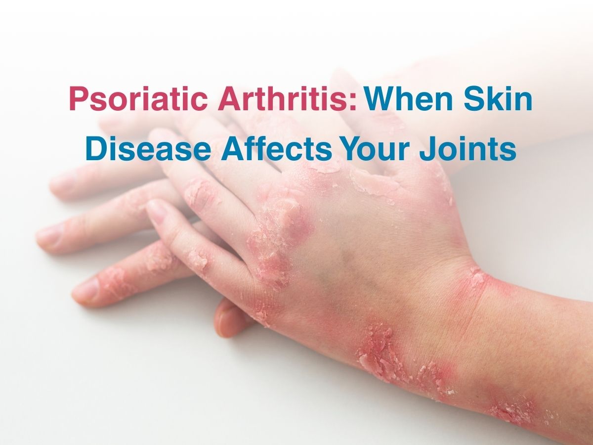 Psoriatic Arthritis: When Skin Disease Affects Your Joints