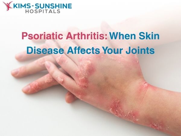 Psoriatic Arthritis: When Skin Disease Affects Your Joints