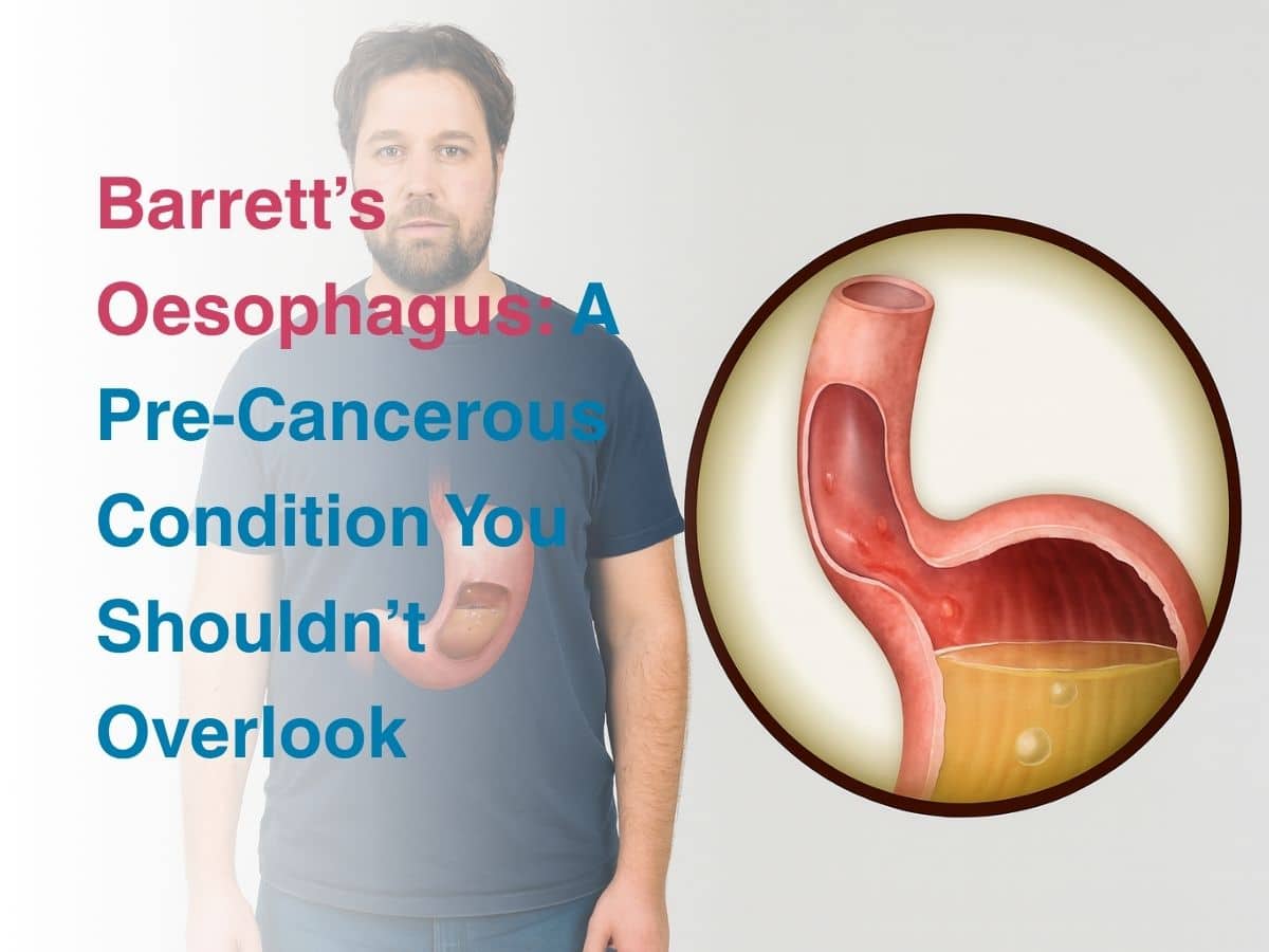 Oct-Barrett’s Oesophagus_ A Pre-Cancerous Condition You Shouldn’t Overlook