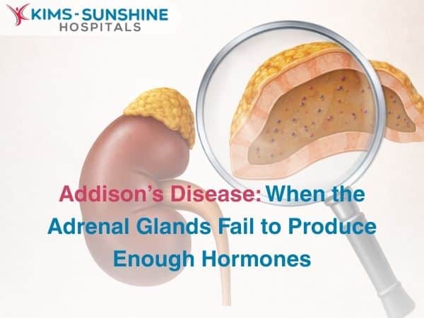 Addison’s Disease: When the Adrenal Glands Fail to Produce Enough Hormones