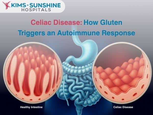 Celiac Disease: How Gluten Triggers an Autoimmune Response