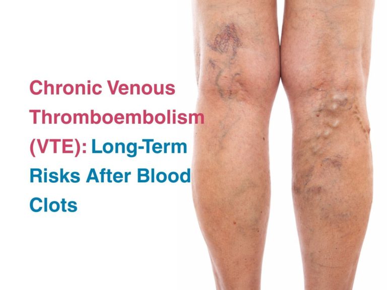 Chronic Venous Thromboembolism (VTE): Long-Term Risks After Blood Clots