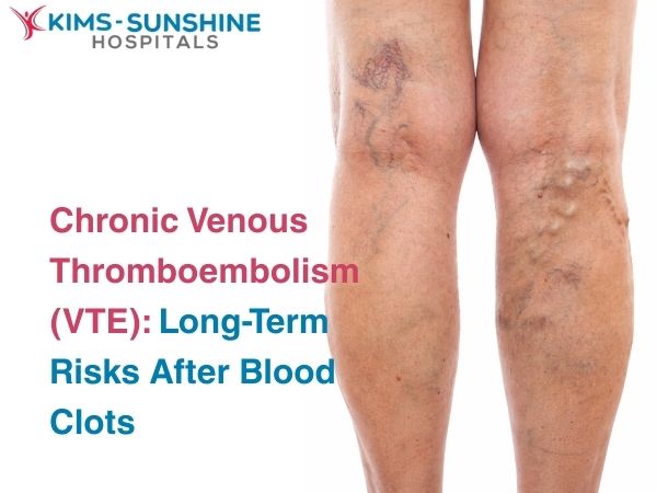 Chronic Venous Thromboembolism (VTE): Long-Term Risks After Blood Clots