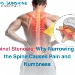 Spinal Stenosis: Why Narrowing of the Spine Causes Pain and Numbness