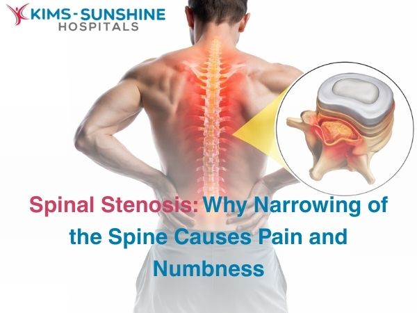 Spinal Stenosis: Why Narrowing of the Spine Causes Pain and Numbness