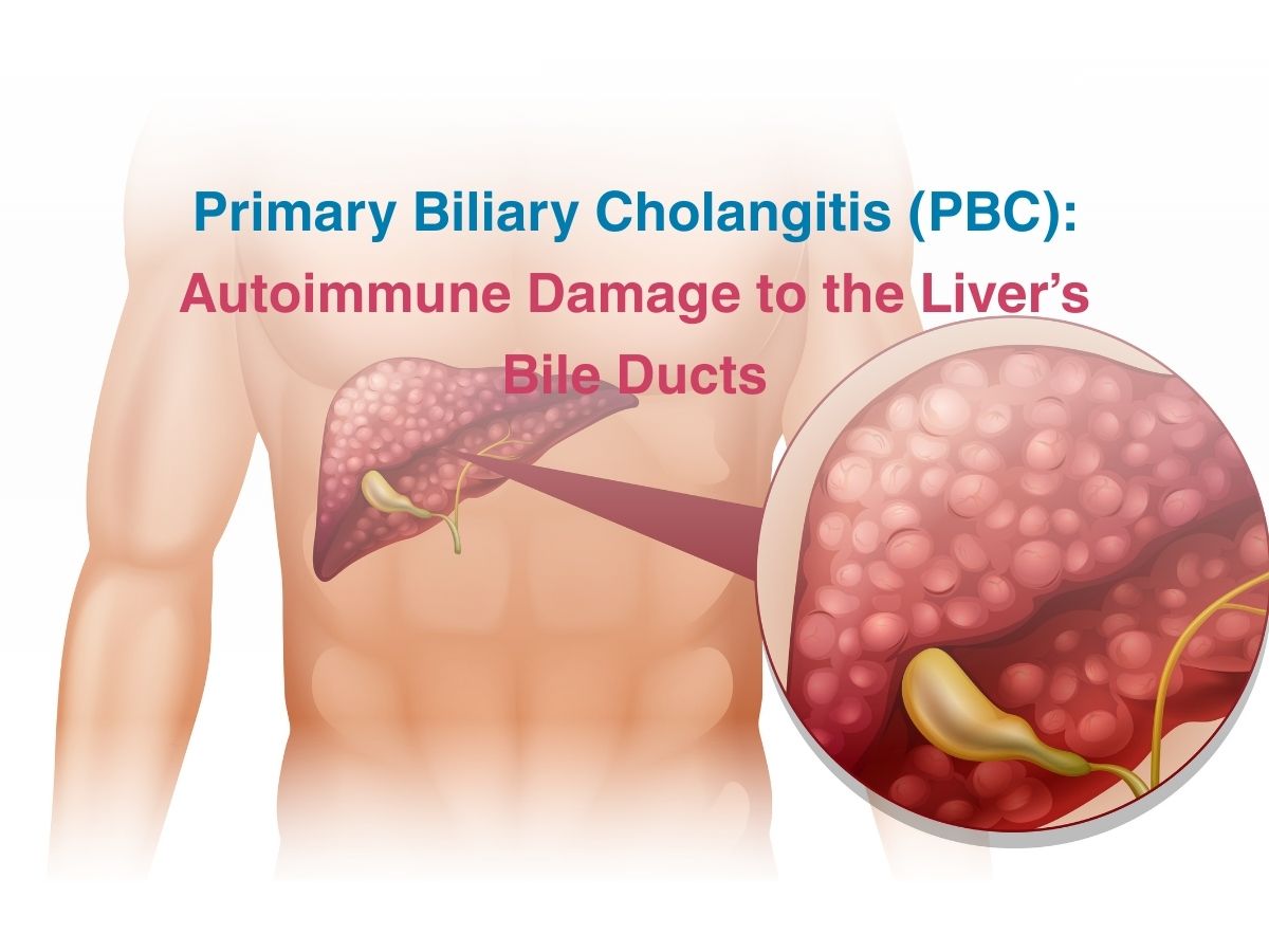 Primary Biliary Cholangitis PBC_ Autoimmune Damage to the Livers Bile Ducts - Multispeciality Hospital Primary Biliary Cholangitis (PBC): Autoimmune Damage to the Liver’s Bile Ducts