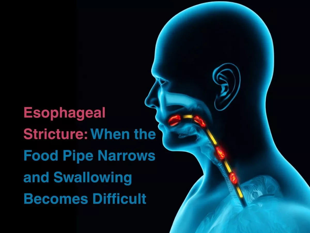 esophageal-stricture-when-the-food-pipe-narrows-and-swallowing-becomes-difficult-699d6b5a0ceea - Multispeciality Hospital Esophageal Stricture: When the Food Pipe Narrows and Swallowing Becomes Difficult