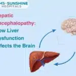 Hepatic Encephalopathy: How Liver Dysfunction Affects the Brain