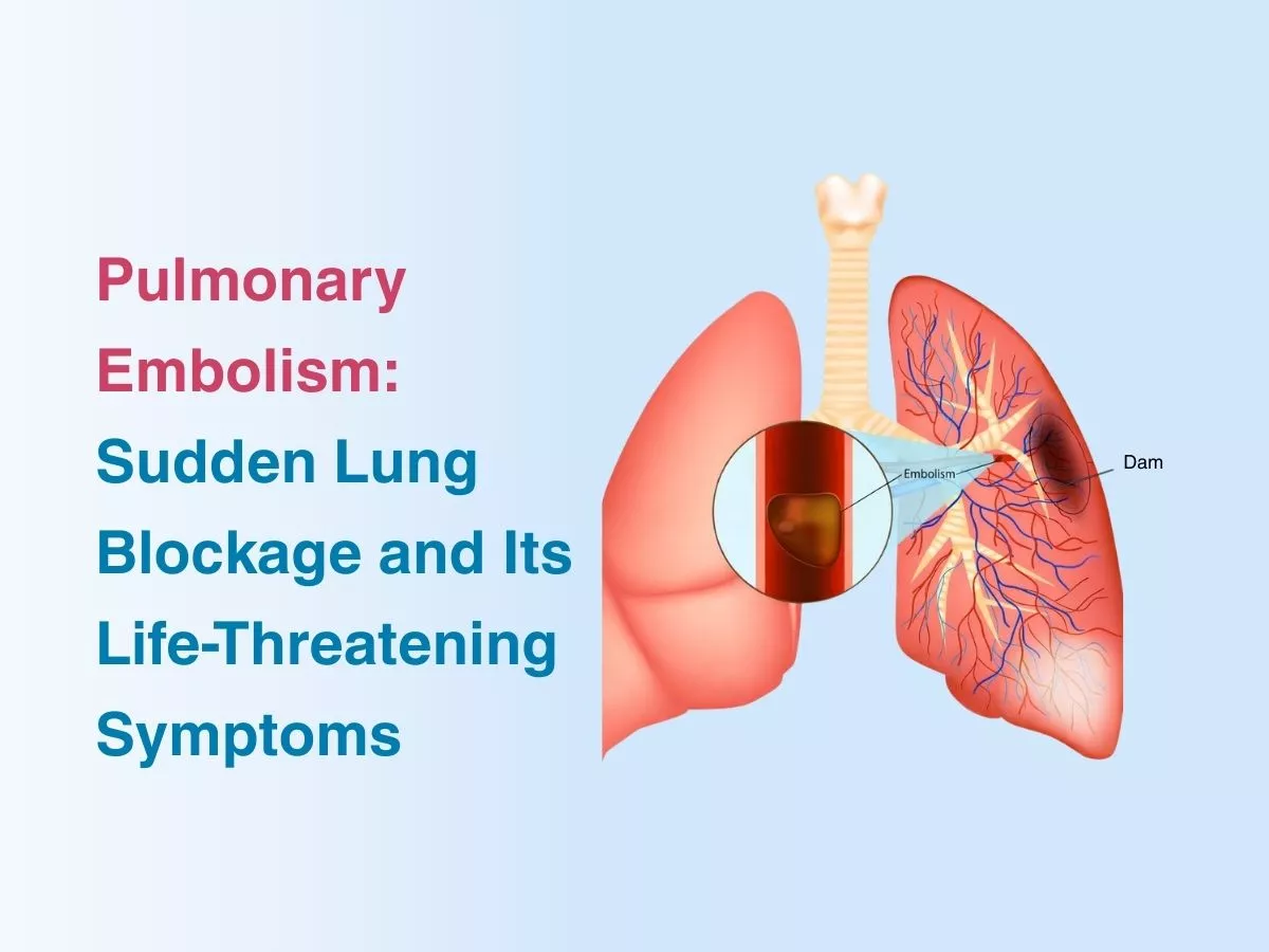 Pulmonary Embolism: Sudden Lung Blockage and Its Life-Threatening Symptoms