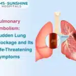 Pulmonary Embolism: Sudden Lung Blockage and Its Life-Threatening Symptoms