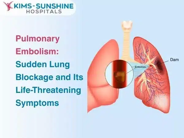 Pulmonary Embolism: Sudden Lung Blockage and Its Life-Threatening Symptoms