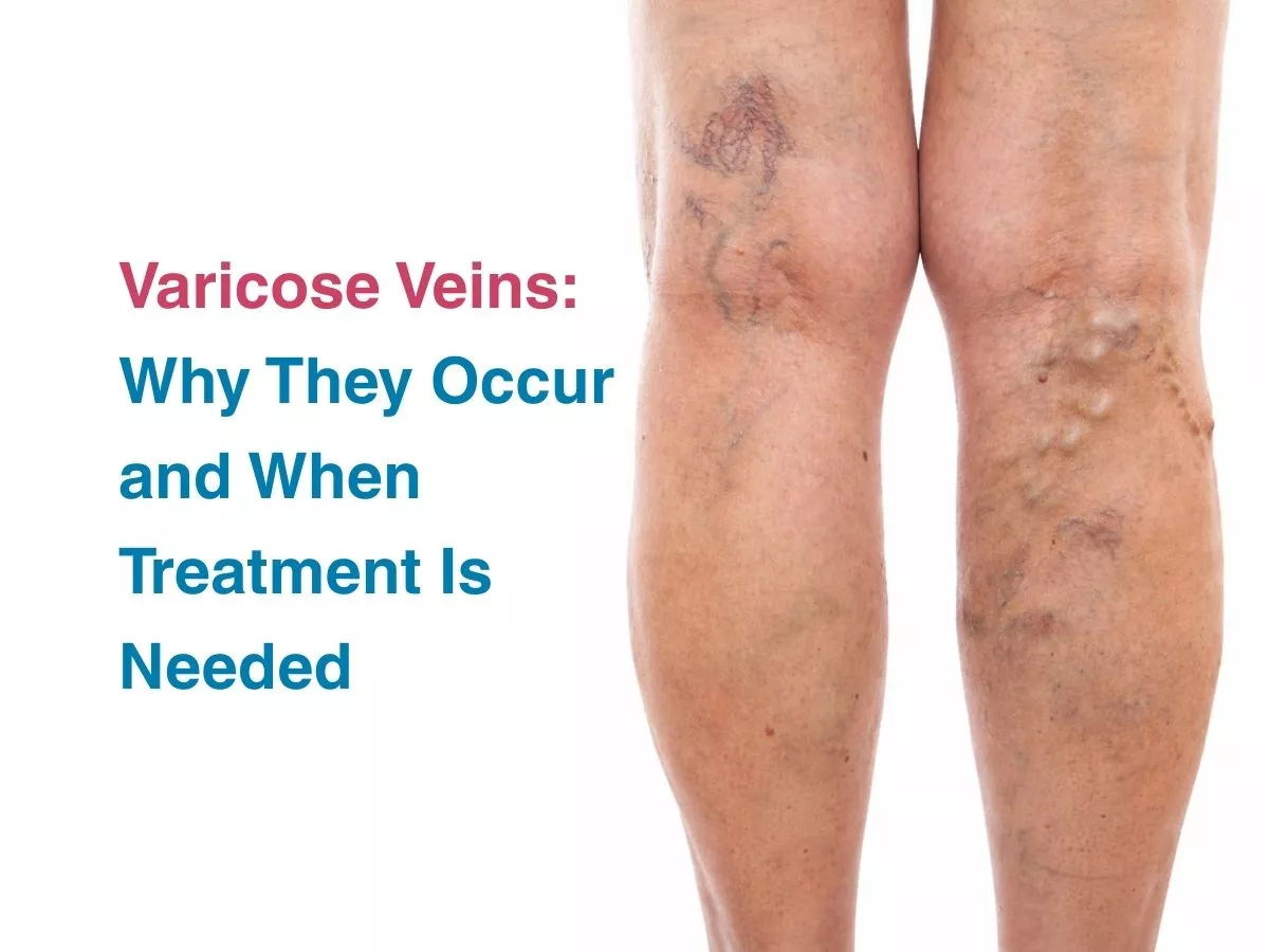 varicose-veins-why-they-occur-and-when-treatment-is-needed-699be965caba1 - Multispeciality Hospital Varicose Veins: Why They Occur and When Treatment Is Needed