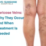 Varicose Veins: Why They Occur and When Treatment Is Needed