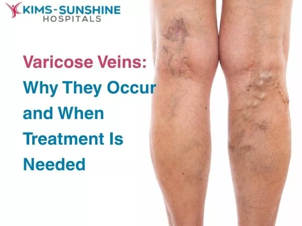 Varicose Veins: Why They Occur and When Treatment Is Needed