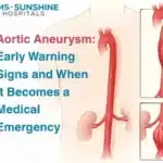 Aortic Aneurysm: Early Warning Signs and When It Becomes a Medical Emergency