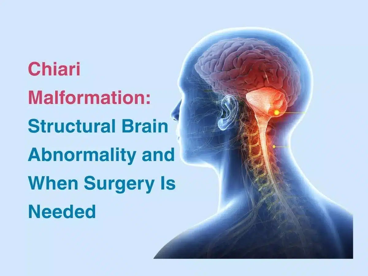 Chiari Malformation: Structural Brain Abnormality and When Surgery Is Needed