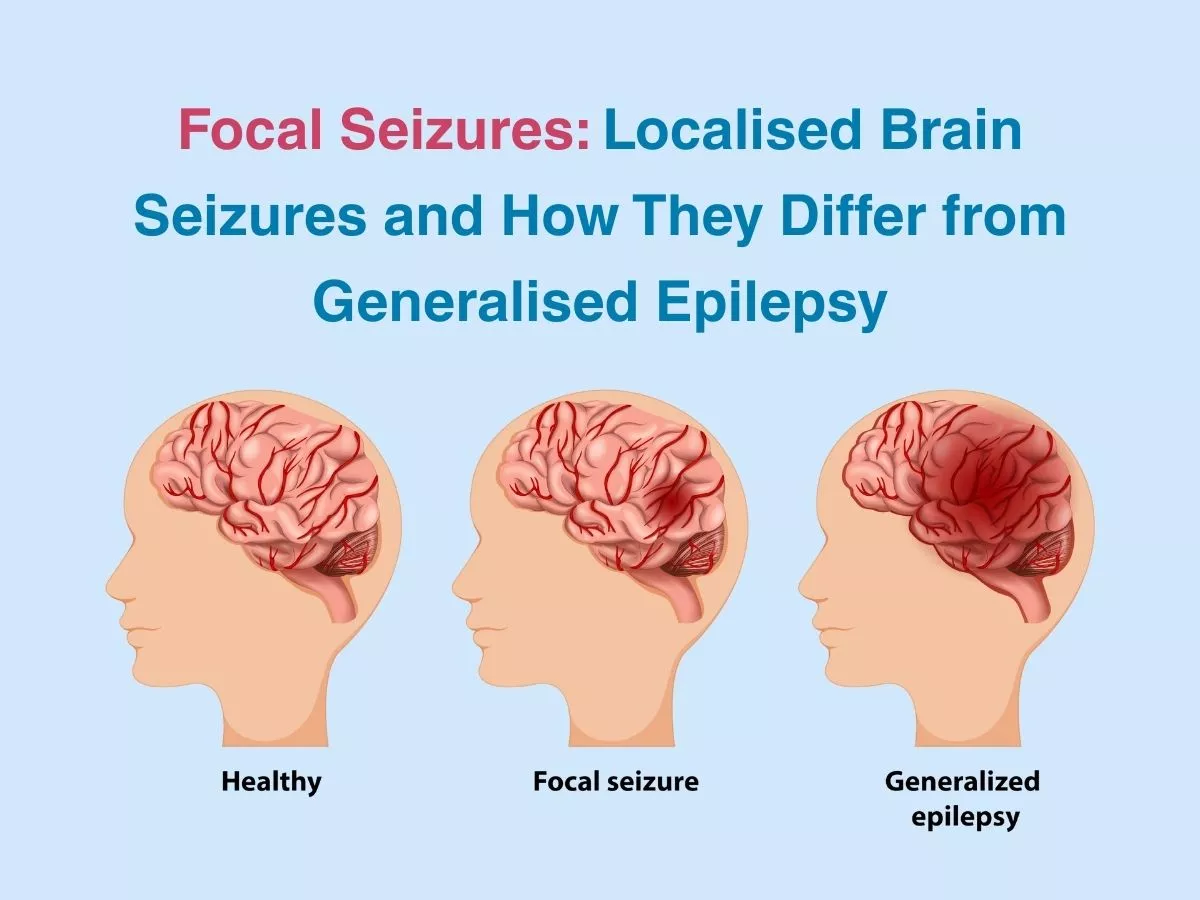 focal-seizures-localised-brain-seizures-and-how-they-differ-from-generalised-epilepsy-69a7badba6755 - Multispeciality Hospital Focal Seizures: Localised Brain Seizures and How They Differ from Generalised Epilepsy