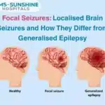 Focal Seizures: Localised Brain Seizures and How They Differ from Generalised Epilepsy