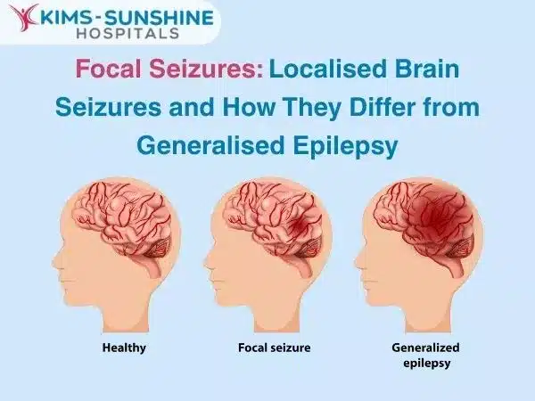 Focal Seizures: Localised Brain Seizures and How They Differ from Generalised Epilepsy