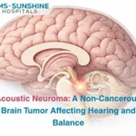 Acoustic Neuroma_ A Non-Cancerous Brain Tumor Affecting Hearing and Balance